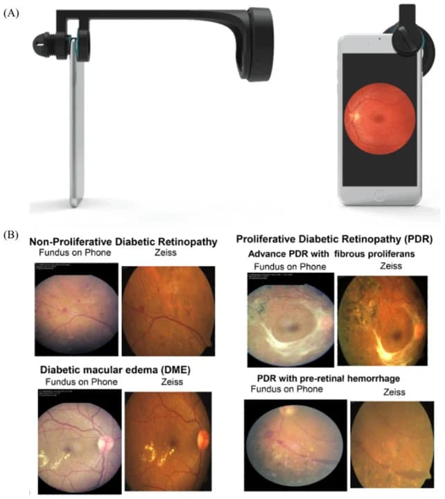 Figure 1. Smartphone-based fundus imaging (SBFI).