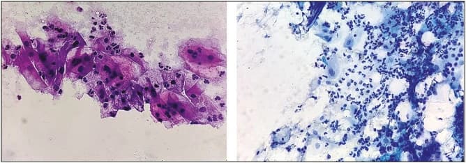 Figure 1. Inflammatory smear negative for intraepithelial lesion or malignancy in 400× magnification.