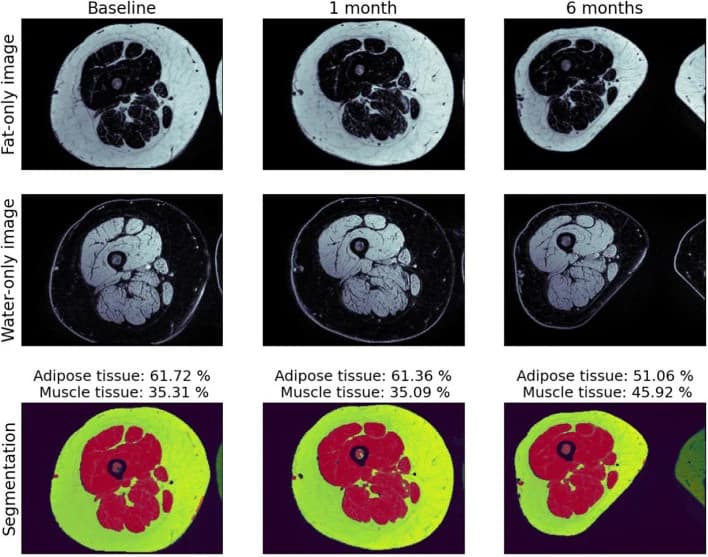 Figure 1. Mri analysis of right lower limb tissue composition at baseline, 1 month, and 6 Months post-surgery.