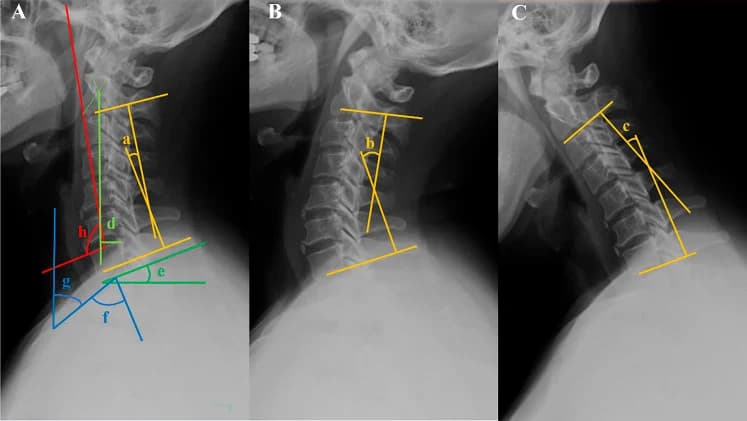 Figure 1. Sagittal parameters of cervical X-rays.