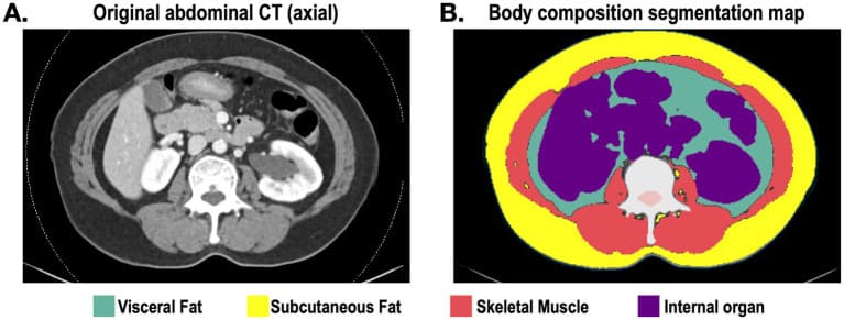 Figure 1. Representative abdominal CT image and automated body-composition segmentation.