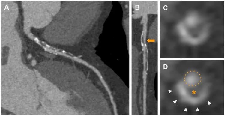 Figure 1. Severe stenotic lesion (orange arrows) of the proximal left anteriod descending (LAD) artery is demonstrated in the curved multiplanar (A) and stretched reconstruction view (B) A cross-sectional…