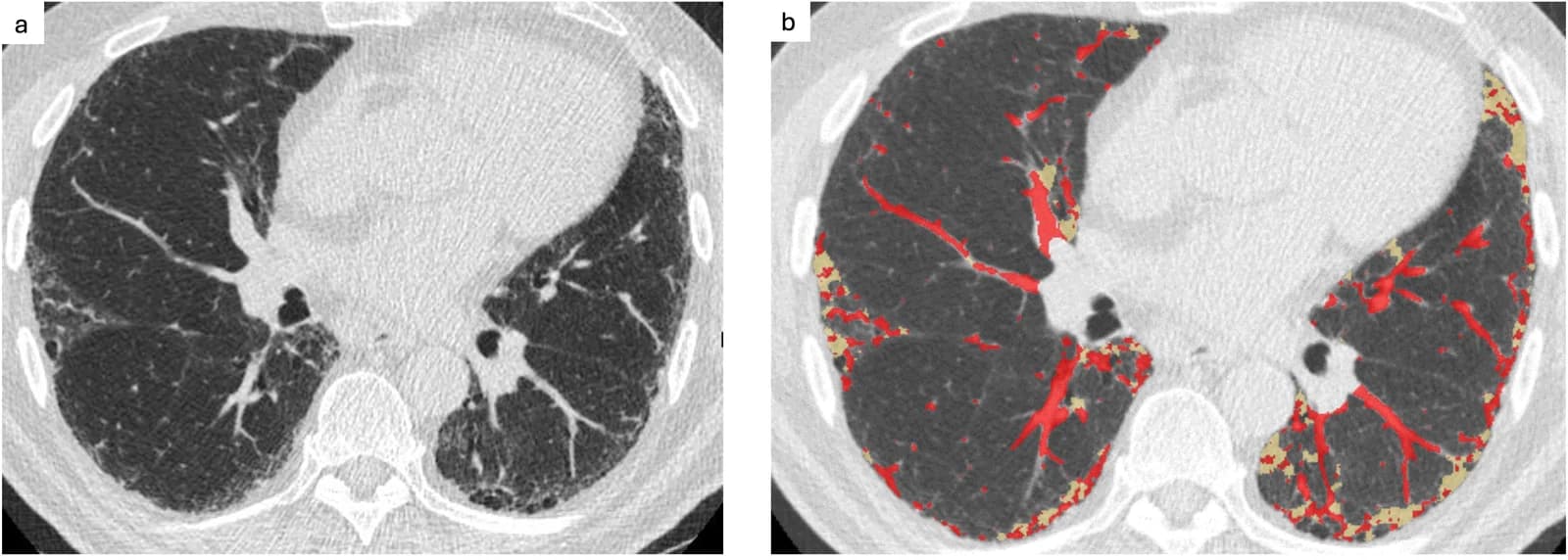Figure 1. CT (a) and quantitative CT (b) in a participant with radiologist-identified ILA >10%.