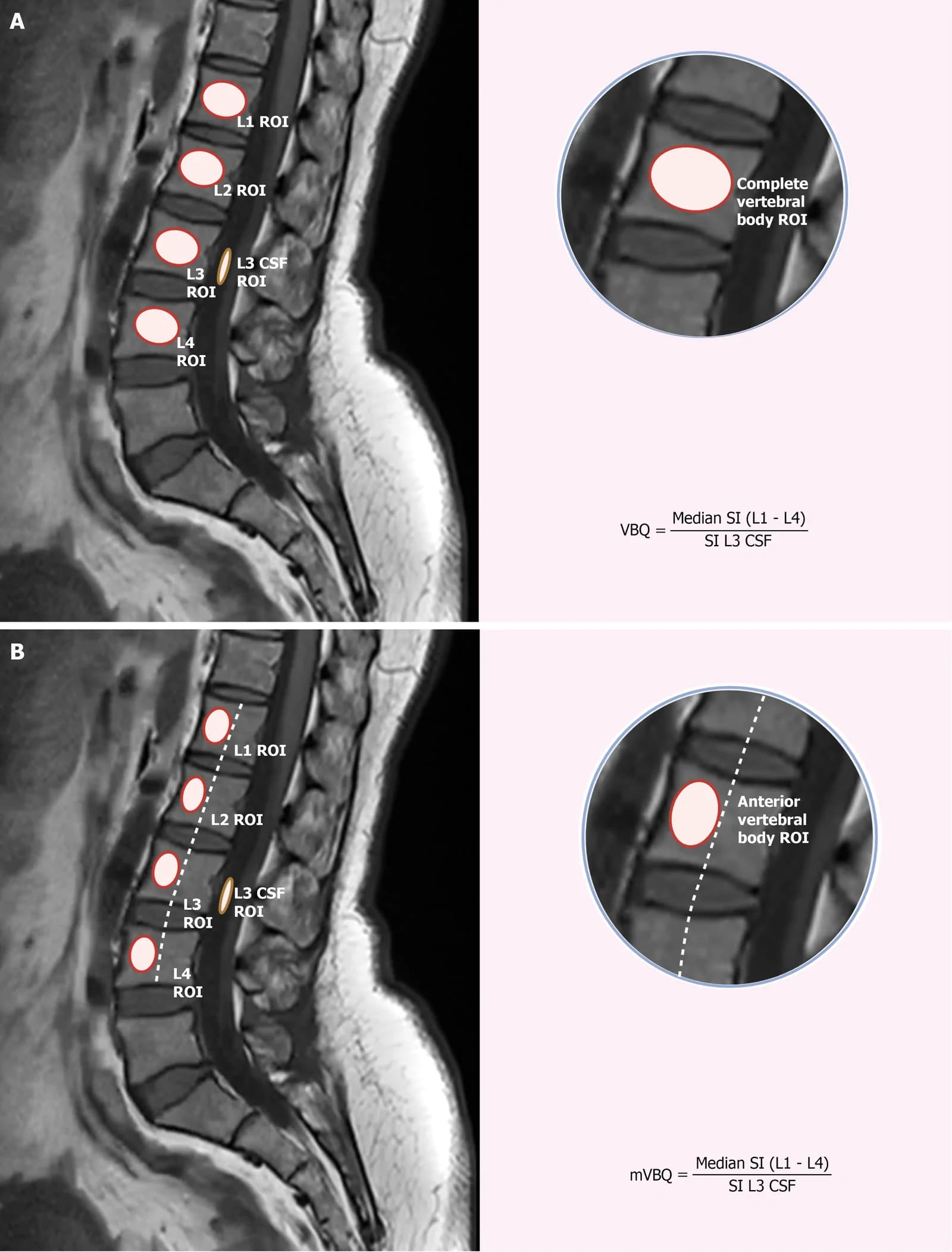 Schematic diagrams for Vertebral Bone Quality score and modified Vertebral Bone Quality score calculation.