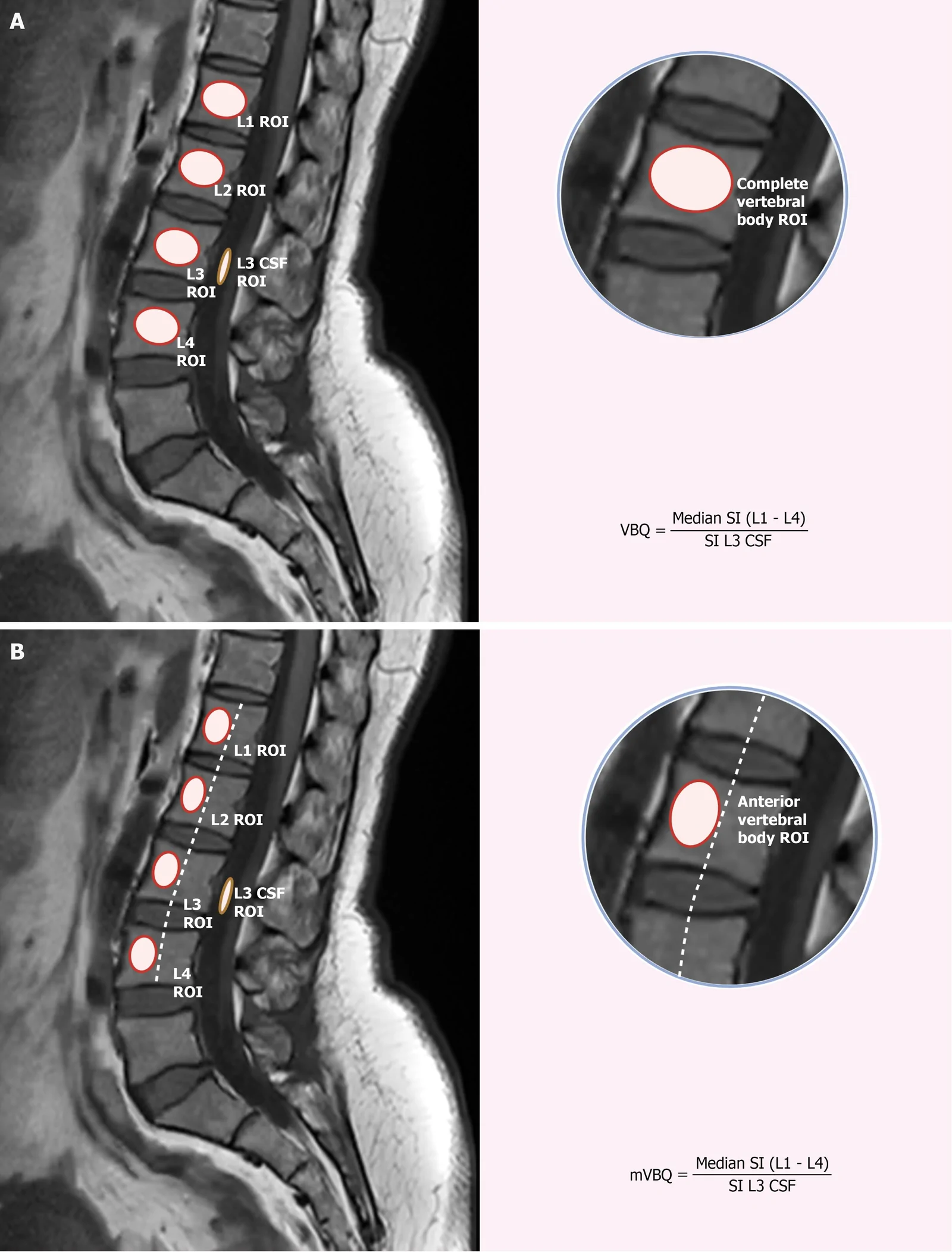 Figure 1. Schematic diagrams for Vertebral Bone Quality score and modified Vertebral Bone Quality score calculation.