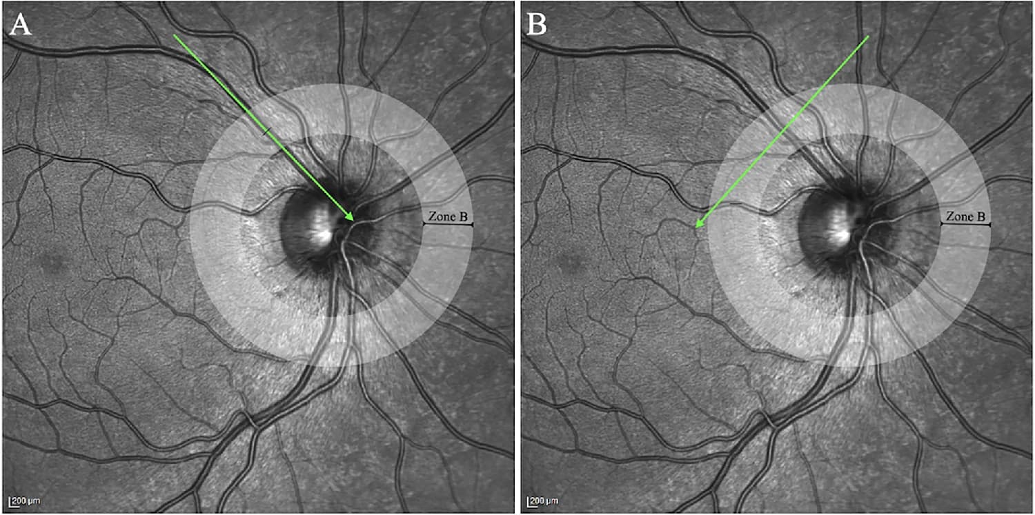 Figure 1. The standardized acquisition protocol applied to each main retinal artery and vein.