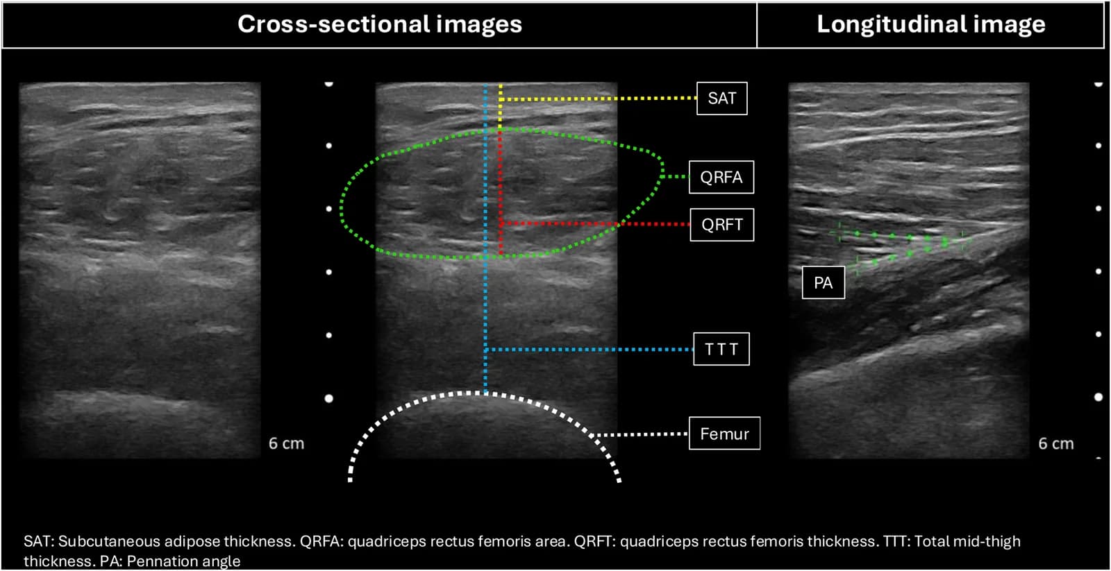 Ultrasound geometric muscle measurements.