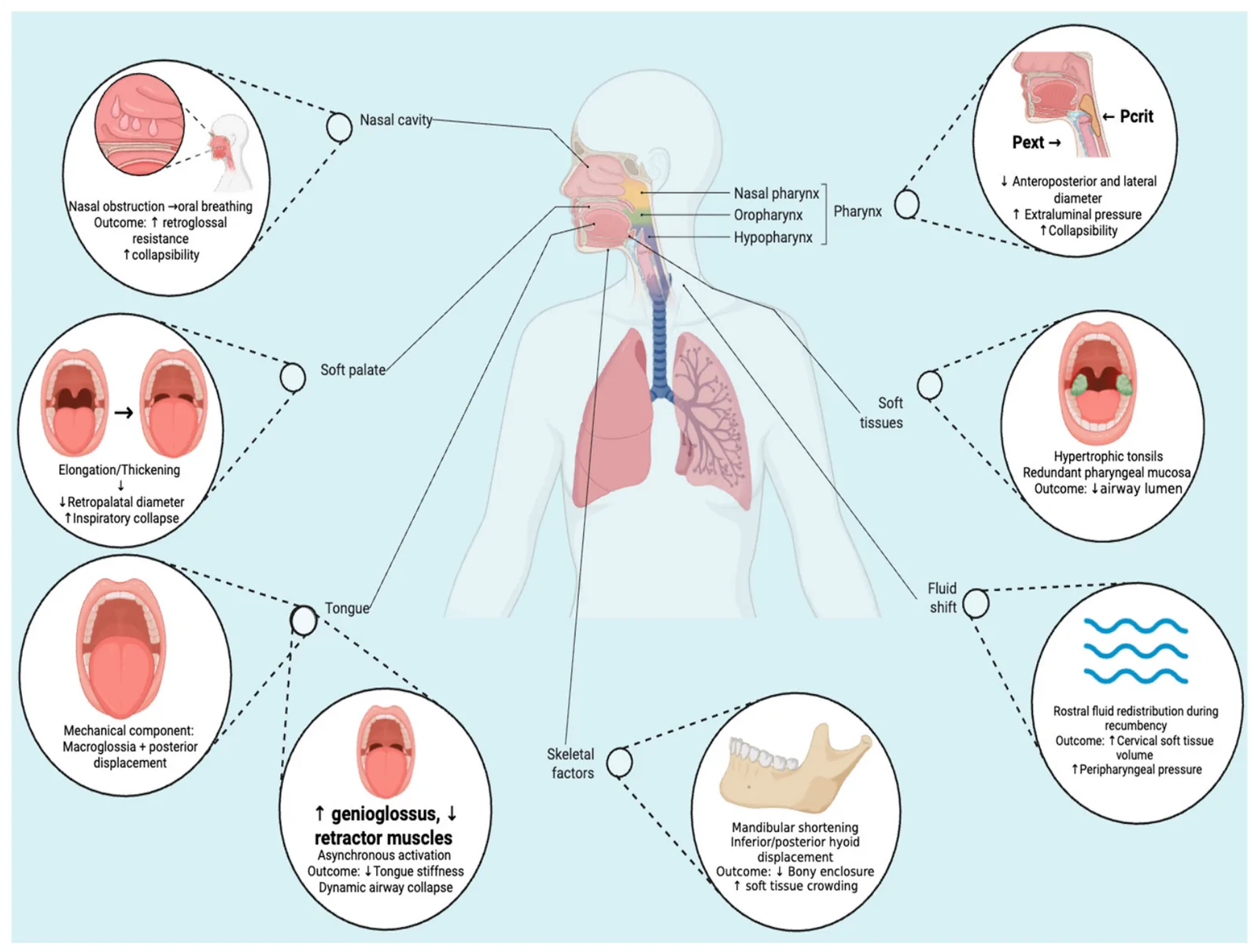 Figure 1. Anatomical and neuromuscular determinants of upper-airway collapsibility in OSA: Structural and functional factors involved in the upper-airway obstruction in obstructive sleep apnea.