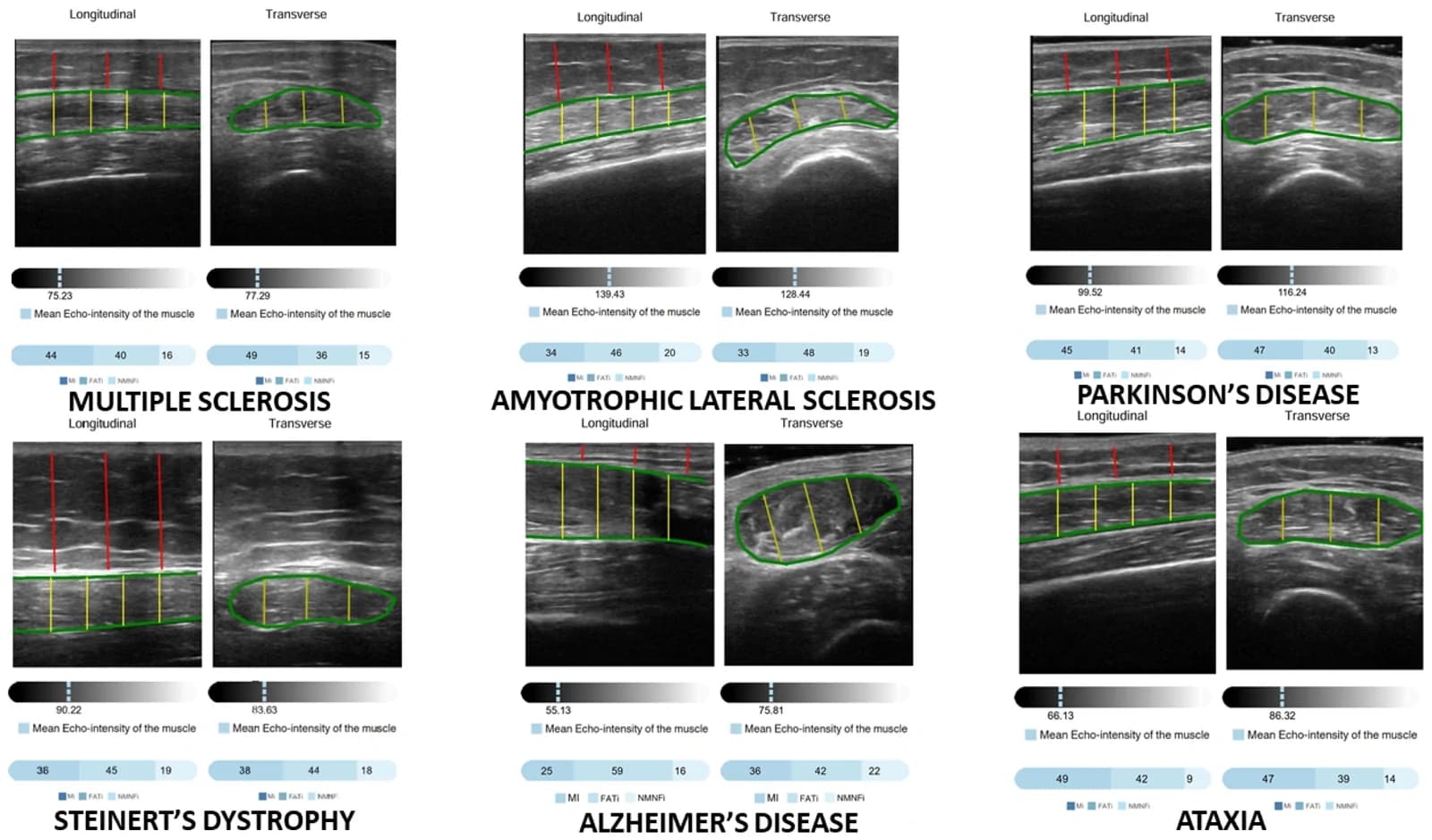 Different rectus femoris ultrasound images analyzed by Artificial Intelligence tool (PIIXMEDTM).