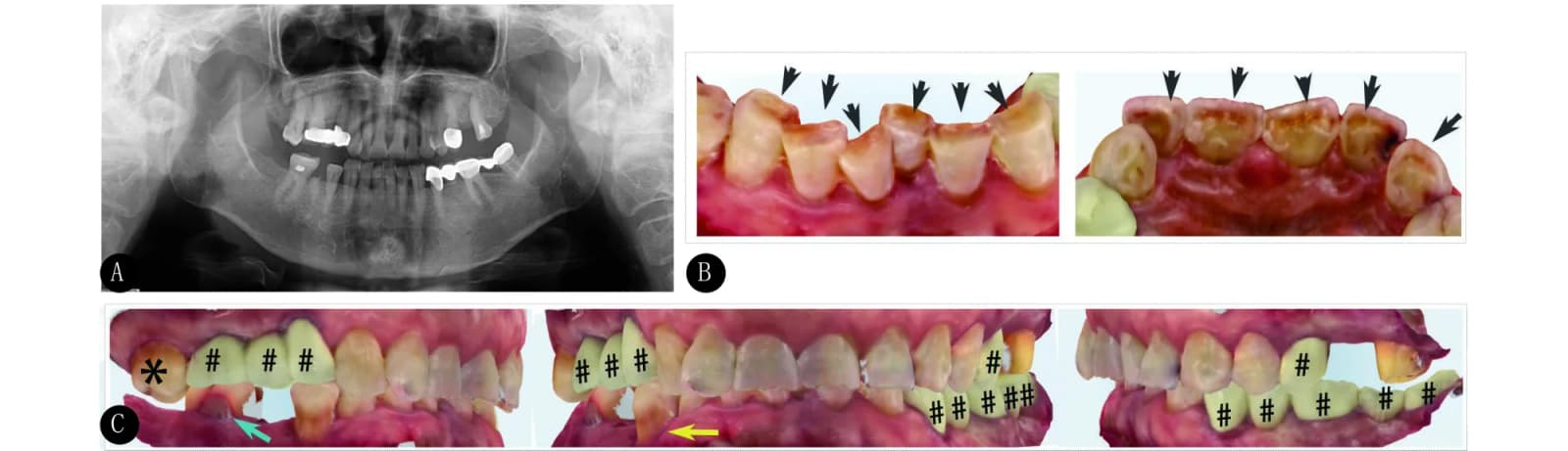 图 1. A case of occlusion obtained from an older adult 老年咬合案例 A, Complete panoramic X-ray; B, occlusal surfaces of upper and lower anterior teeth.