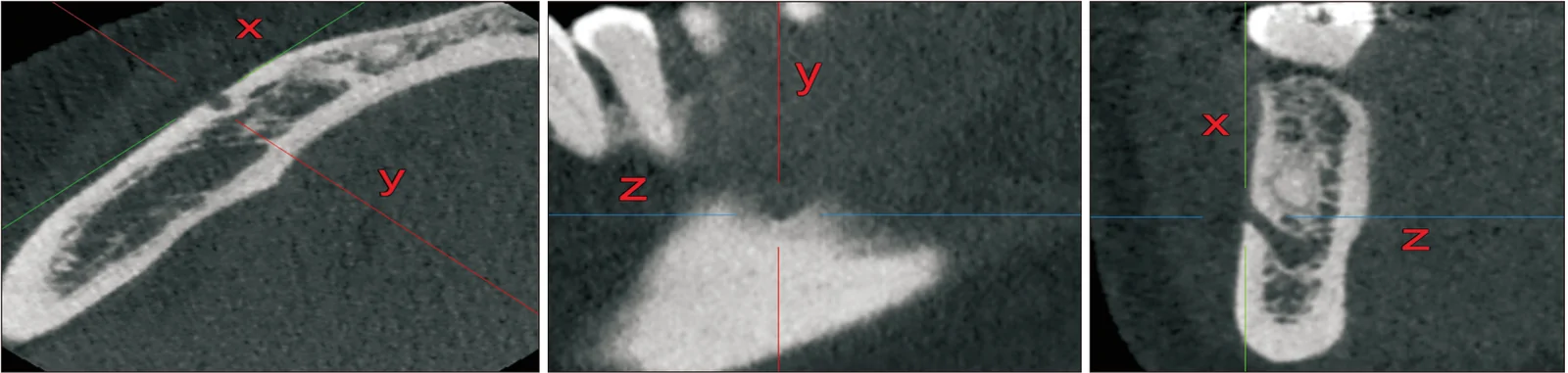 Fig. 1. On the axial image, an antero- posterior tangent line “x” is drawn, and line “y” and “z” are drawn perpendicular to line “x” through the center of the mental foramen, then these lines become…