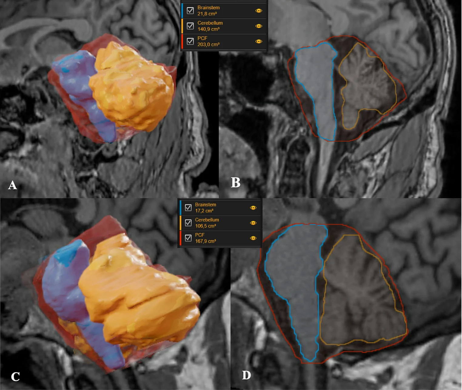 Fig. 1. Representative examples of semi-automated volumetric segmentation of the posterior cranial fossa (PCF), cerebellum, and brainstem using Brainlab Segmentation software.