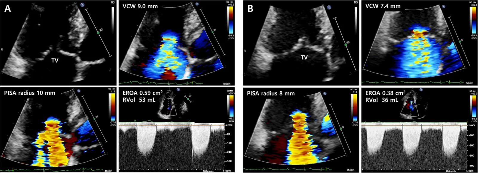 Fig. 1. Baseline echocardiography shows tethering of tricuspid valve with severe functional tricuspid regurgitation (TR).