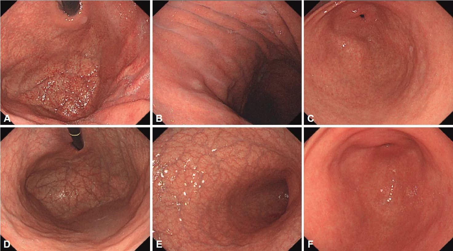 Fig. 1. Autoimmune gastritis masked by H. pylori–associated inflammation.