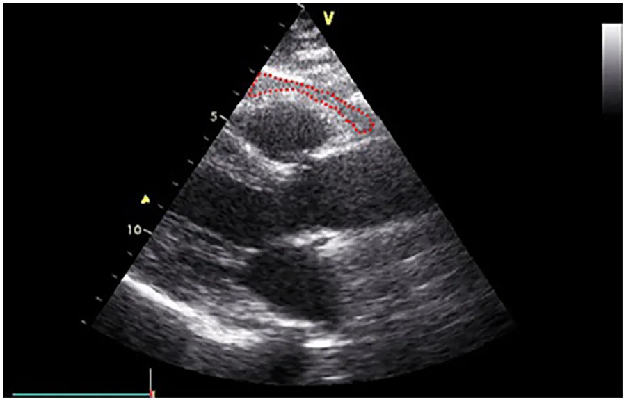 Figure 1. Echocardiographic measurement of epicardial fat thickness (EFT).