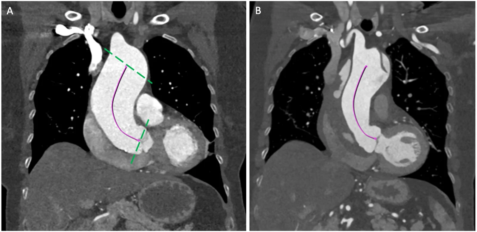 Figure 1. The AAL automatic measurements in multislice computed tomography angiography (CTA) were performed along the software-generated central line (purple) with syngo.via (siemens AG, Germany).