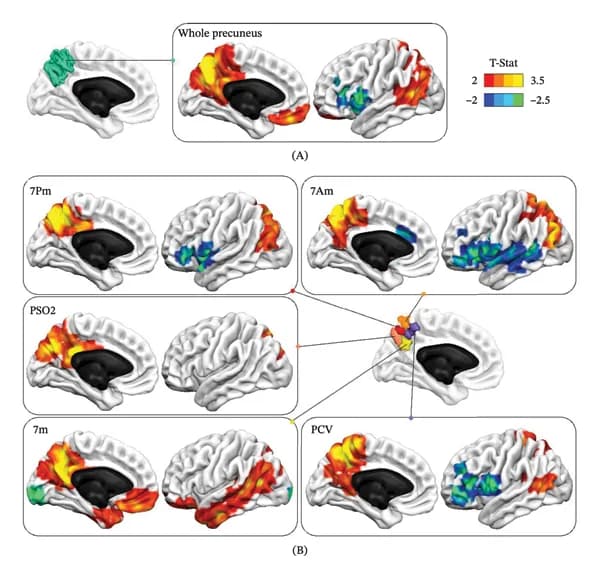 Figure 1. Seed‐based connectivity (SBC) maps of the whole precuneus and its subregions in the noncarrier group.