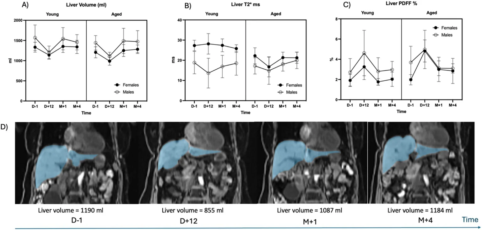 Figure 1. (A) Liver volume, (B) apparent relaxation time T2* and (C) PDFF significant variations during the fasting intervention, with sex-related differences and age-related effects showing different pattern…