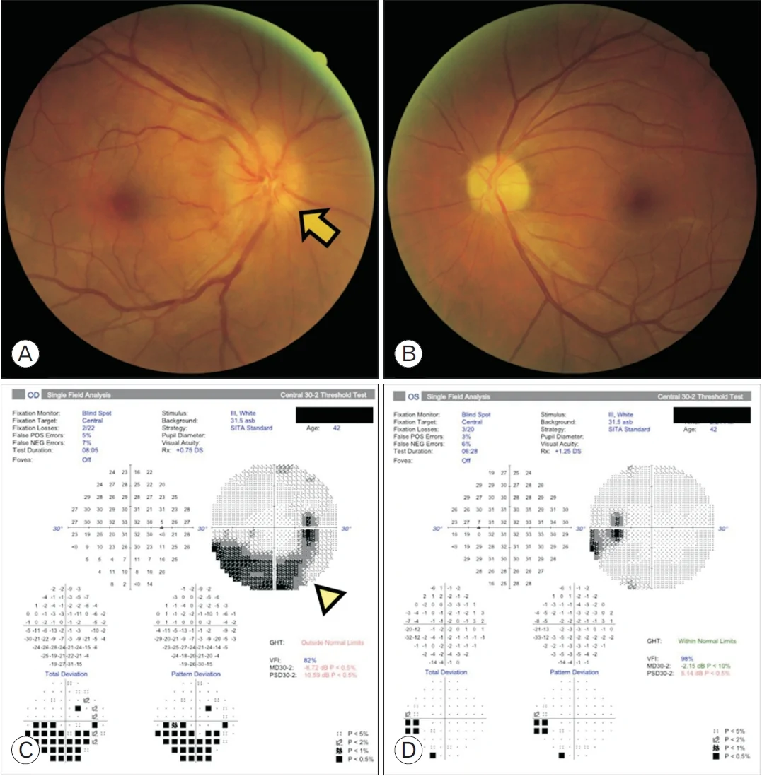 Figure. 1. Initial ophthalmic findings in a 42-year-old man who developed nonarteritic anterior ischemic optic neuropathy after rapid weight loss during semaglutide therapy.