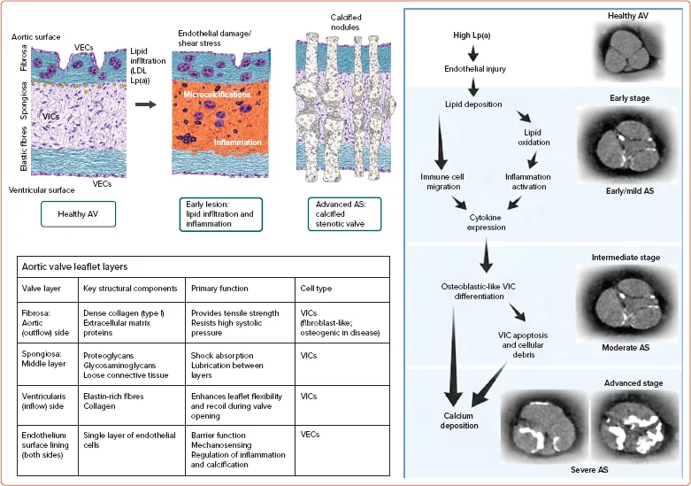 Figure 1. Mechanisms of Lipoprotein(a)-mediated Aortic Stenosis Progression