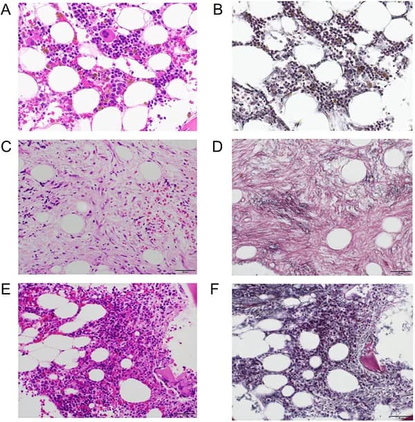 Figure 1. Sequential bone marrow histology before, during, and after eltrombopag therapy.