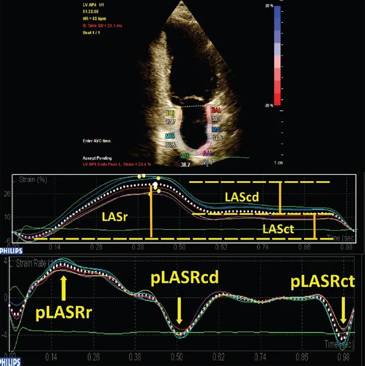 Figure 1. The image showcases 2D speckle-tracking echocardiography of the left atrium in the apical two-chamber view.