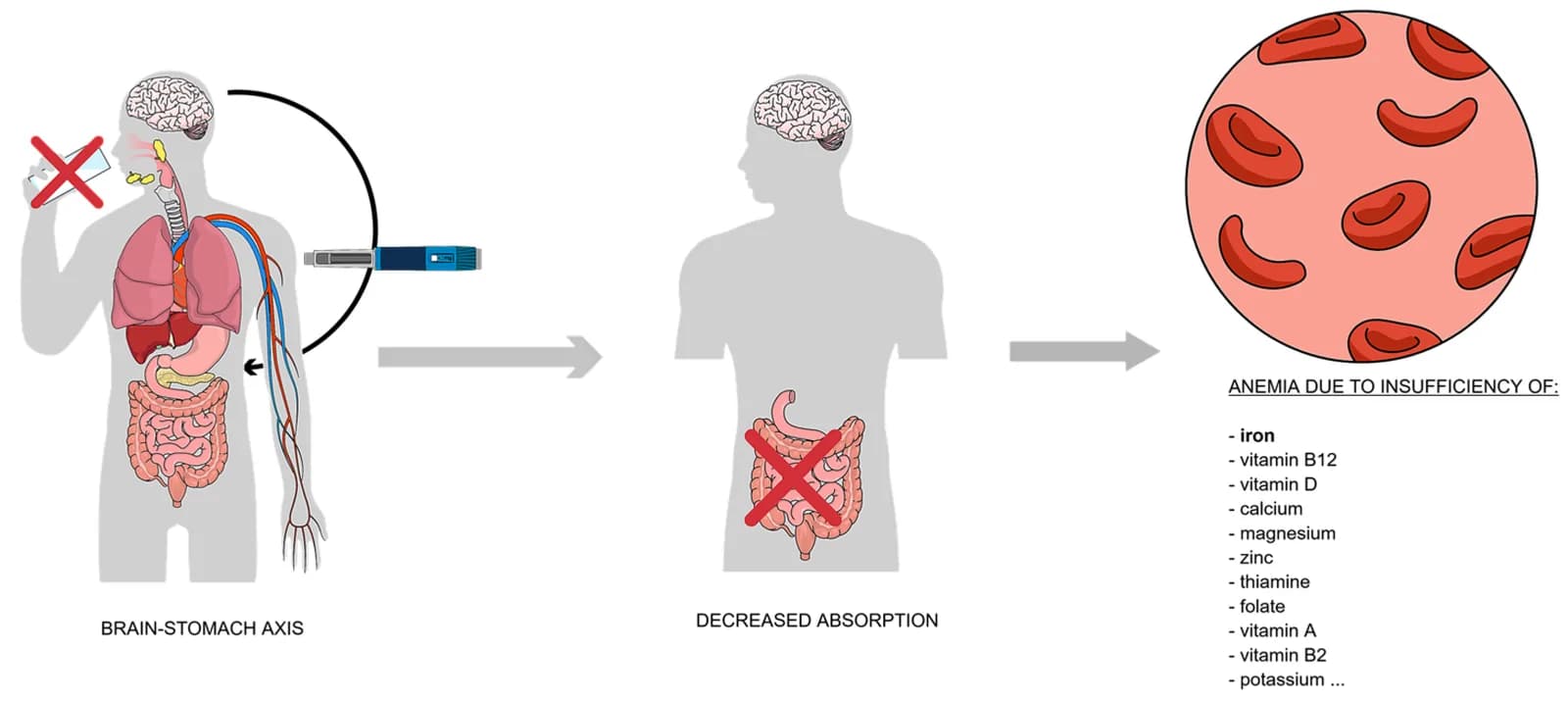 Proposed pathways that may contribute to hematological and nutritional changes during incretin-based therapy.