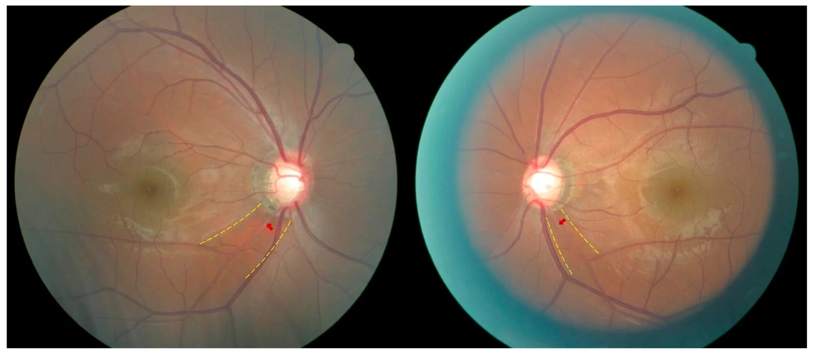 Representative Fundus Photographs of Bilateral Fundus Photograph–Defined Glaucoma with Retinal Arteriosclerosis.