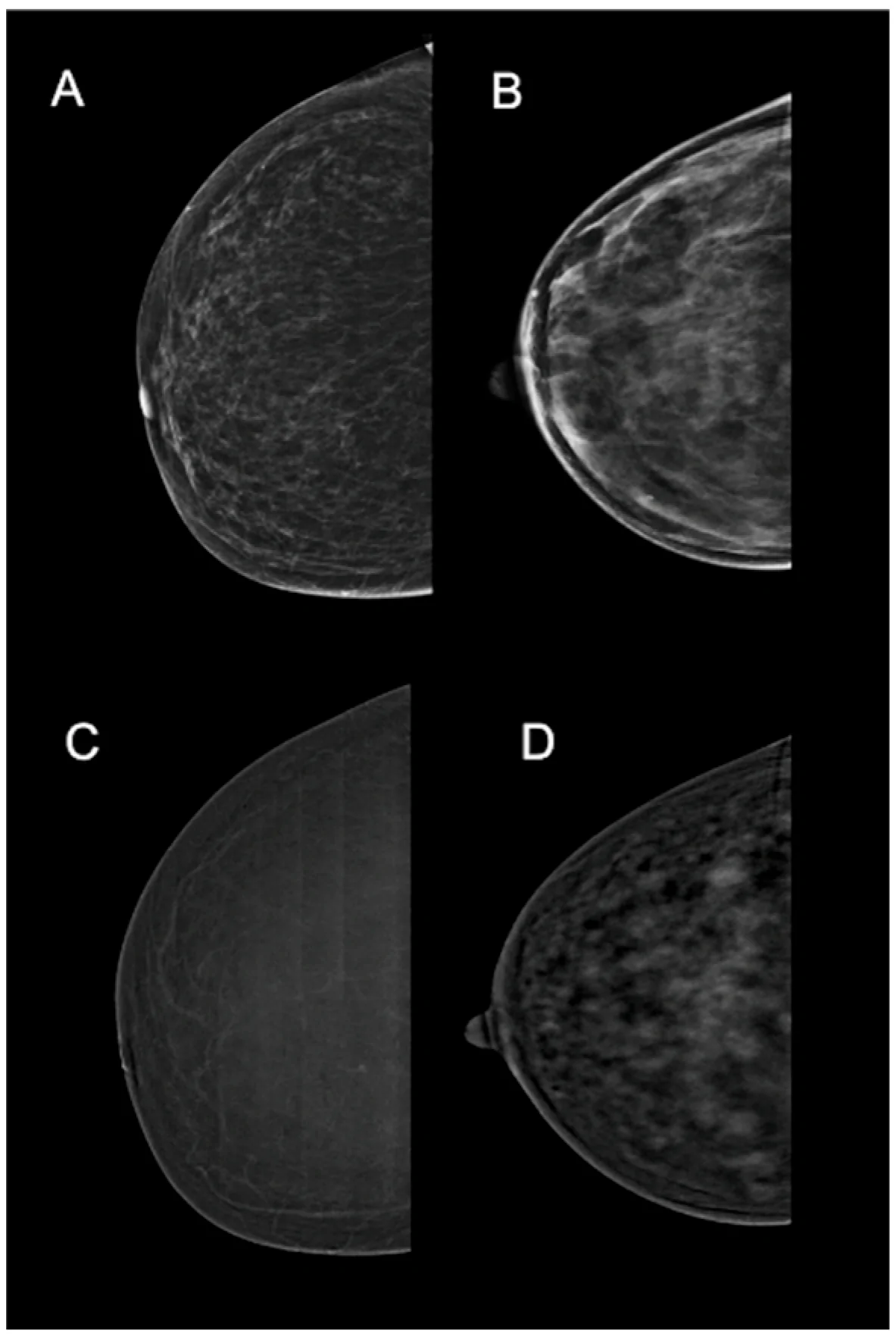 Representative clinical spectrum of structural (BD) and functional (BPE) imaging features on mammography and contrast-enhanced mammography (CEM).