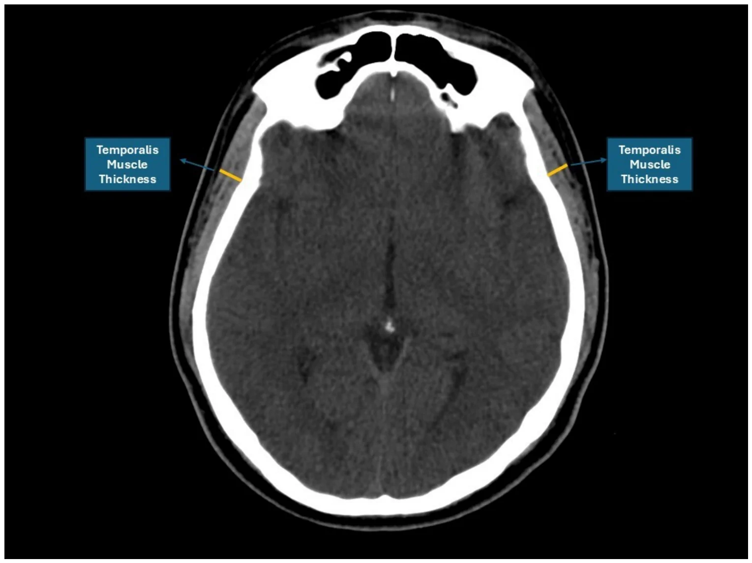 Figure 1. Representative axial non-contrast brain CT image demonstrating bilateral temporalis muscle thickness measurement.