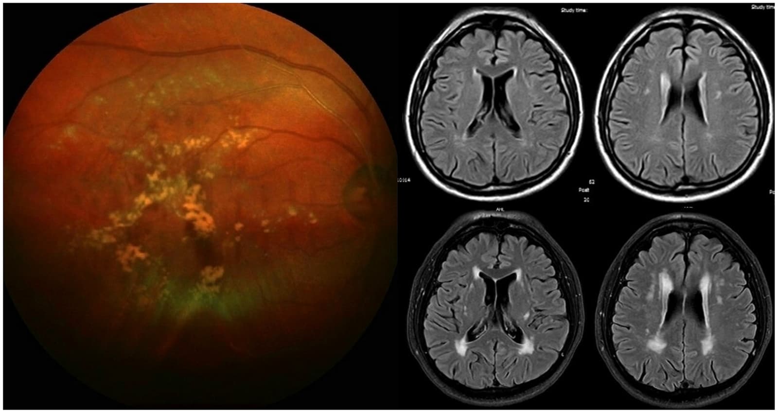 Figure 1 from Journal of Stroke and Cerebrovascular Diseases
