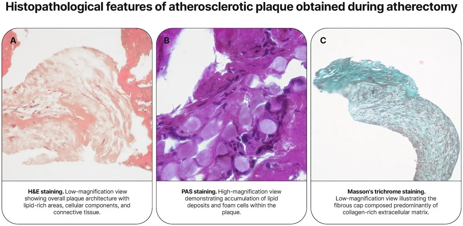 Figure 1. Representative histopathological features of advanced atherosclerotic plaque morphology in anonymized archival educational material.