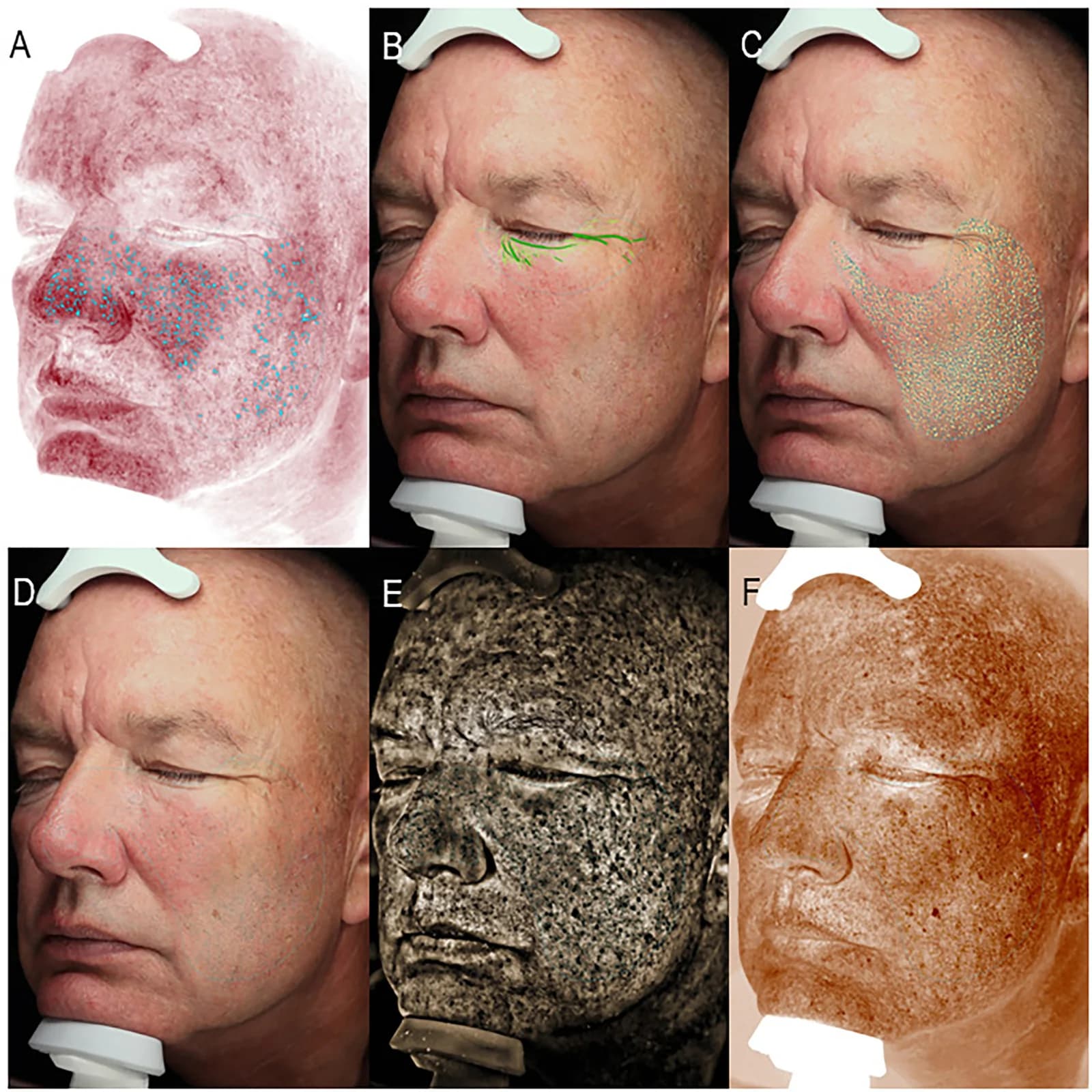 Fig. 1. VISIA images of the right facial view showing: (A) red features (cross-polarized lighting), (B): wrinkles (standard flash), (C) texture (standard flash), (D) visible spots (standard flash), (E) UV…
