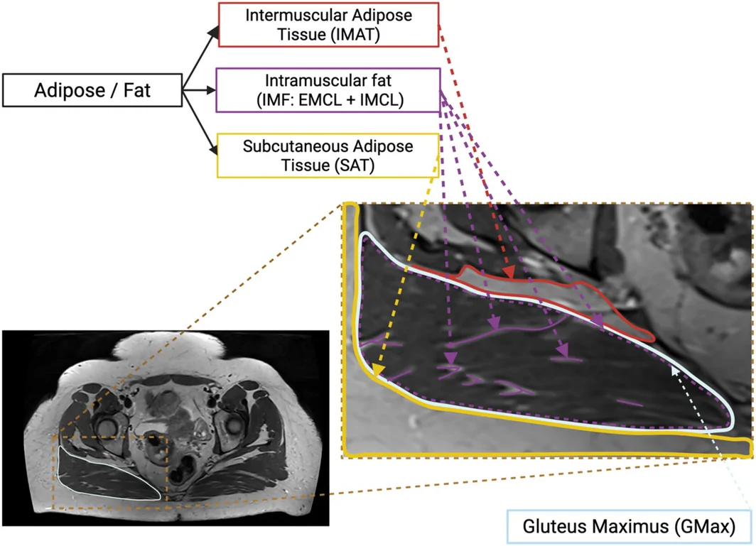 Figure 1. Adipose tissue compartments on a T1‐weighted magnetic resonance (MR) image of the pelvis.