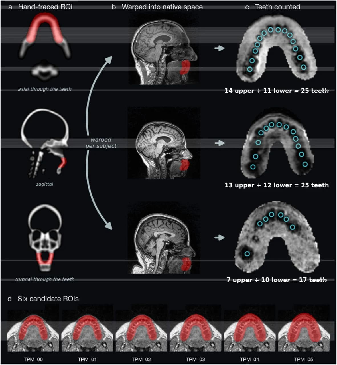 Bite-box extraction from whole-head T1w MRI.