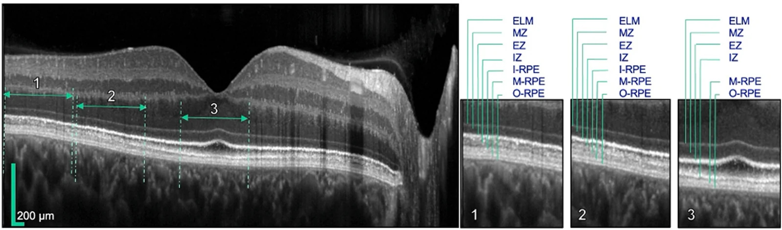Figure 1. High-resolution OCT image through the fovea.