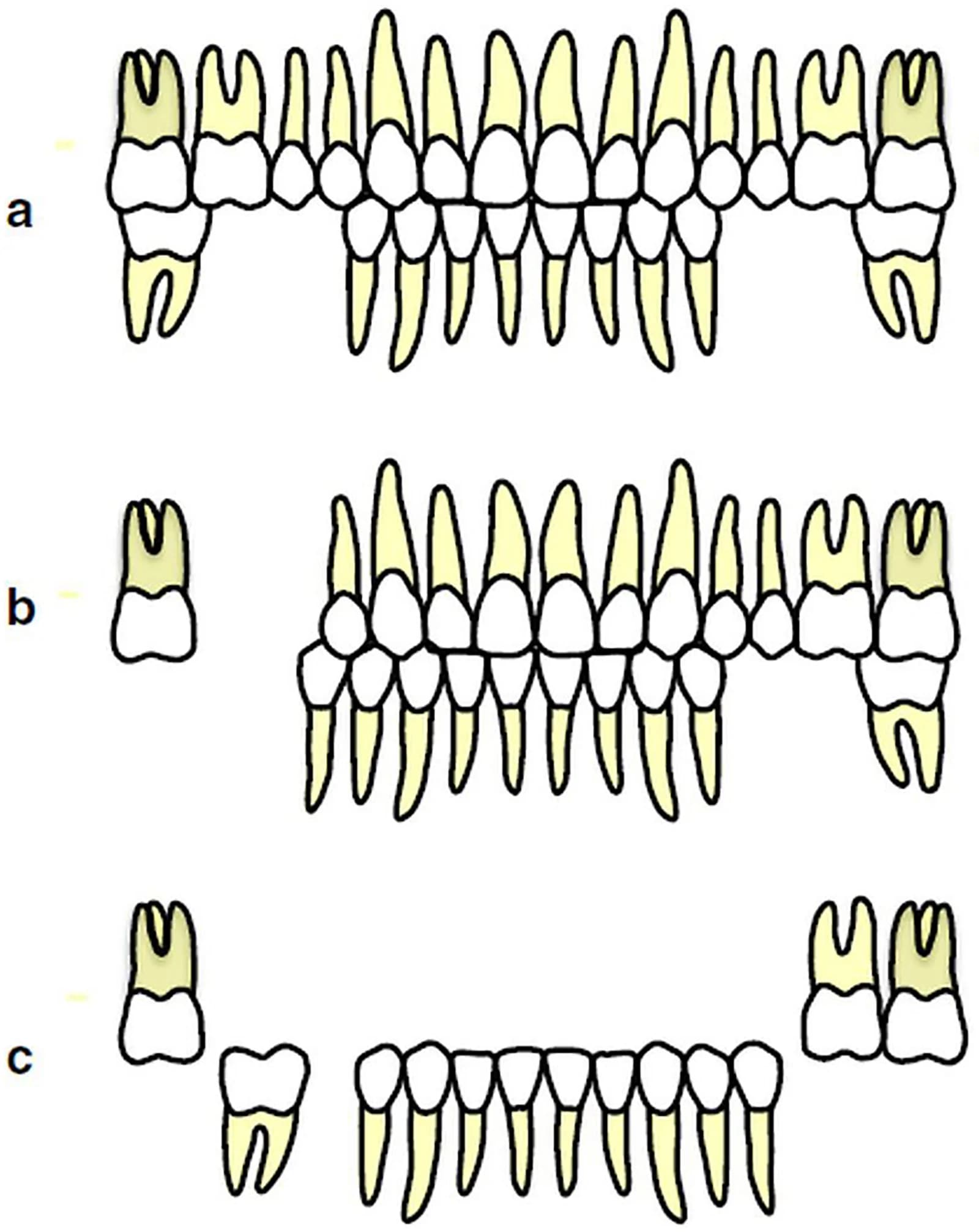 Eichner Index (EI) Classification.