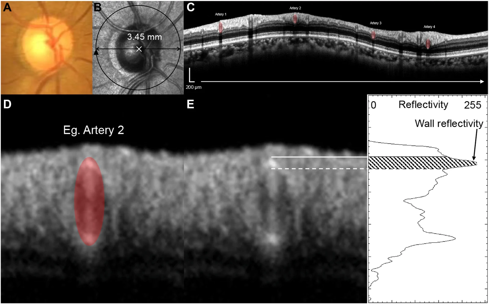 Figure 1. Quantification of retinal arterial parameters using OCT.
