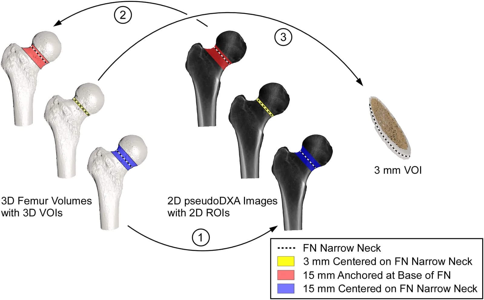Figure 1. Schematic illustrating the pseudoDXA image generation and femoral neck (FN) VOI extraction workflow.