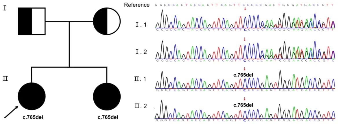 Pedigree chart of patient and sequencing results of the PHKG2 mutations.