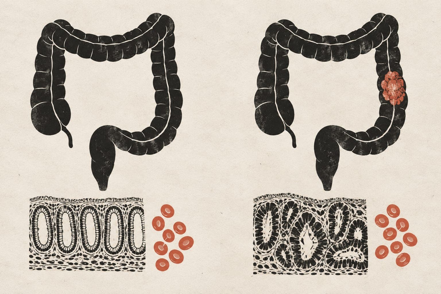 Large intestines sit above tissue samples and blood cells, contrasting an intact colon and orderly glands with a tumour and crowded, irregular glands.