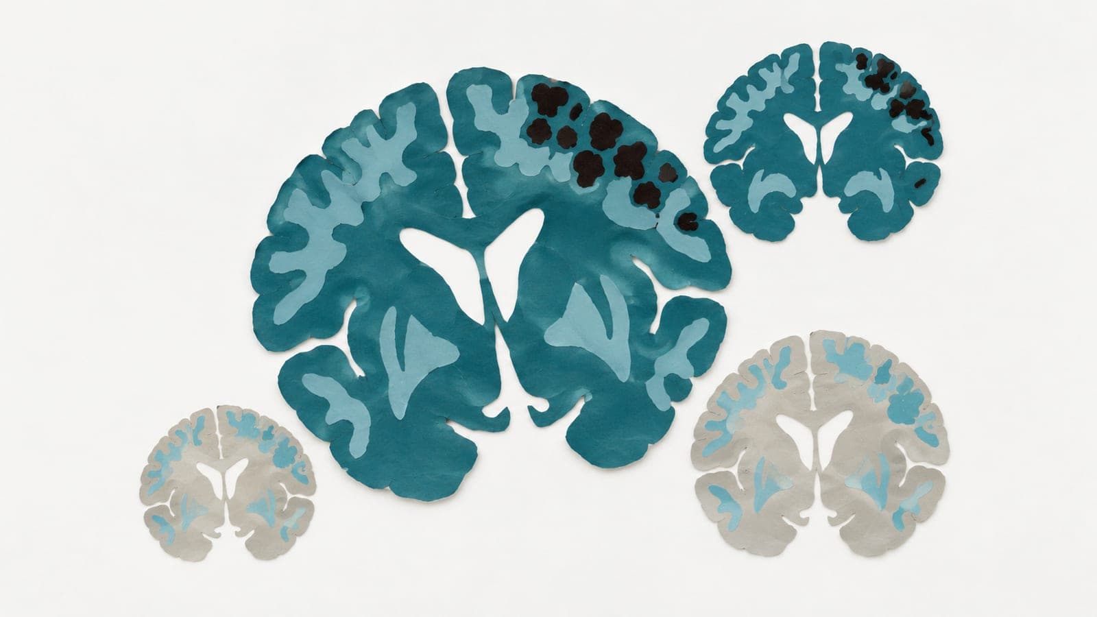 Brain cross-sections show varying dark activity patches in dark blue-green tissue beside gray sections with repeating pale patterns.